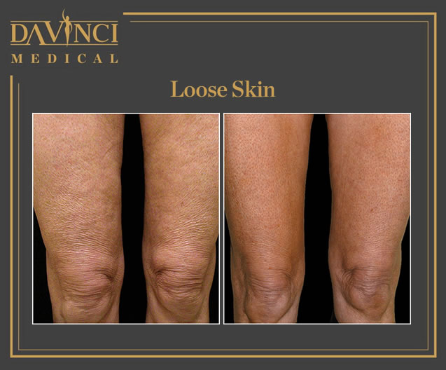 Da Vinci Clinic - Cellulite Skin Tightening & Firming using Thermage