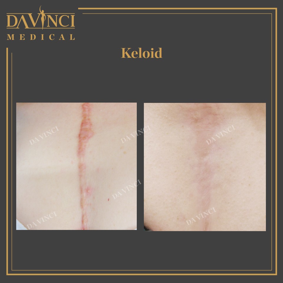 Da Vinci Clinic Keloid Hypertrophic Scar Treatment