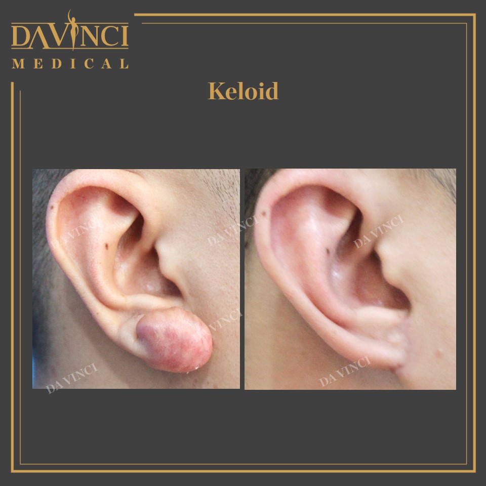 Keloid