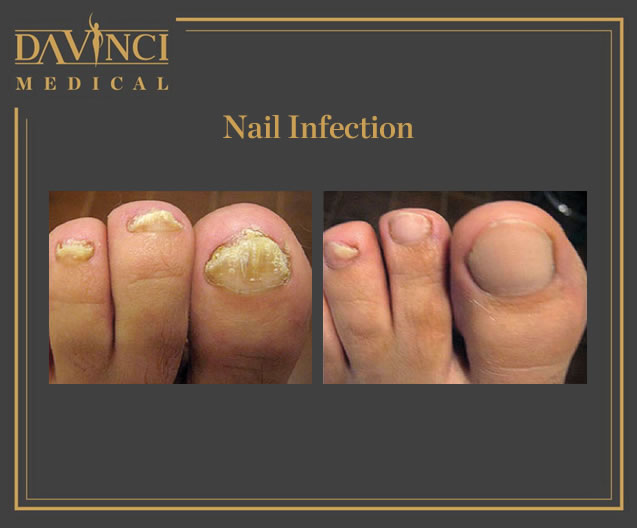 Nail Infections