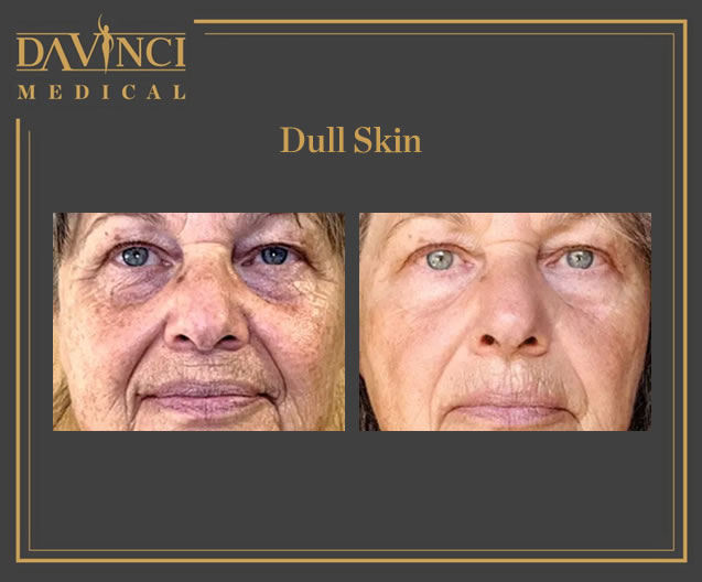 Dull Skin