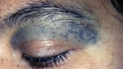 nevus-of-ota