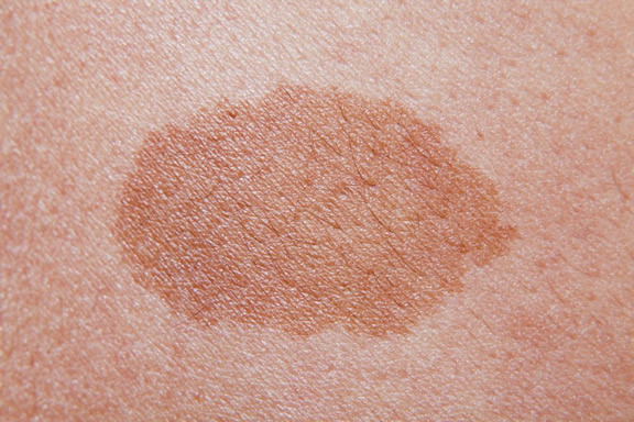 pigmented-birthmarks