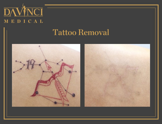 Tattoo & Birthmark Removal