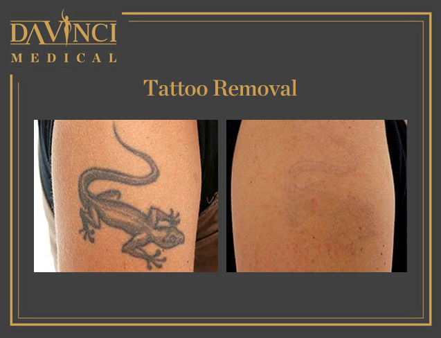 Tattoo & Birthmark Removal