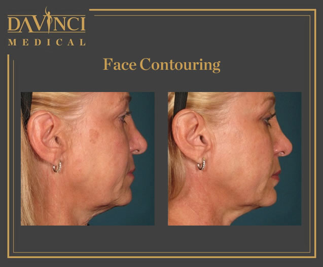 Face Contouring