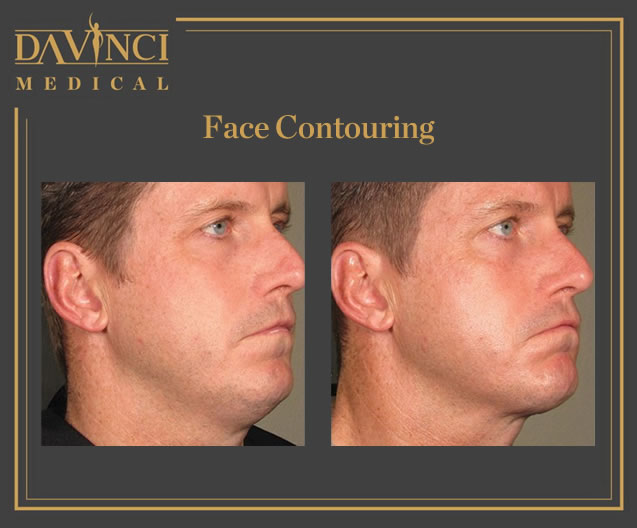 Face Contouring