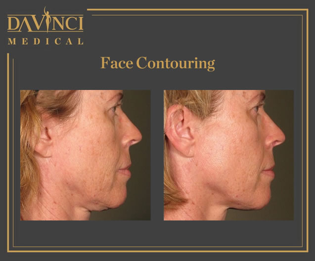 Face Contouring