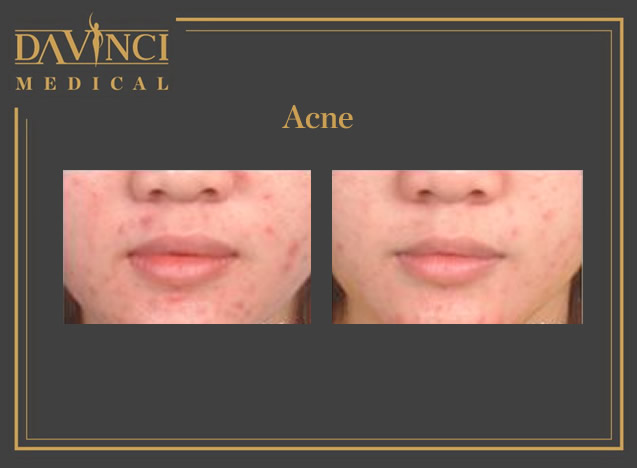 Da Vinci Clinic - Acne Scars Treatment using Lutronic Spectra XT Laser