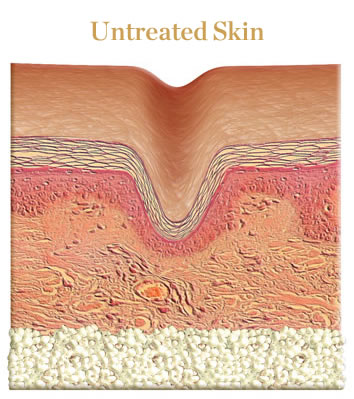 Da Vinci Clinic - Saggy & Dull Skin Treatment using Dermal Filler Injection