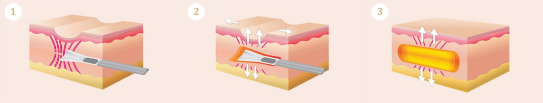 Subcision