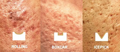 Acne Scars & Depressed Scar