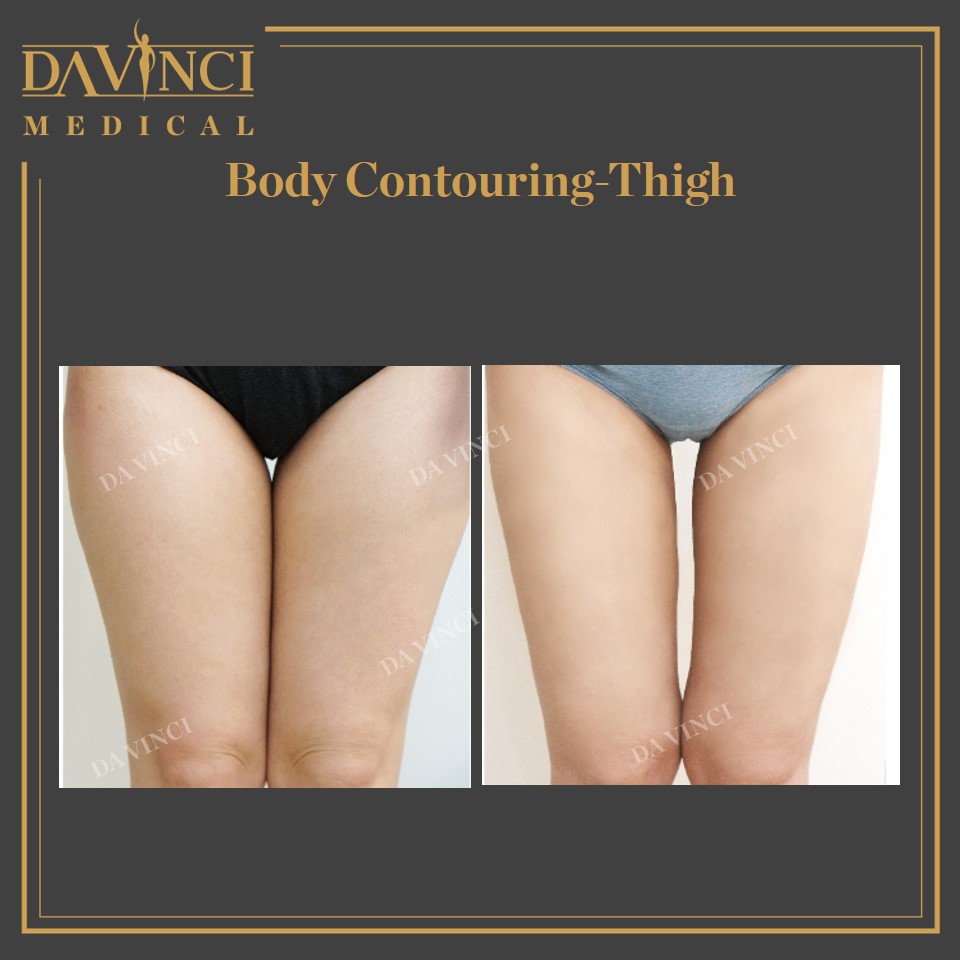 Body Contouring