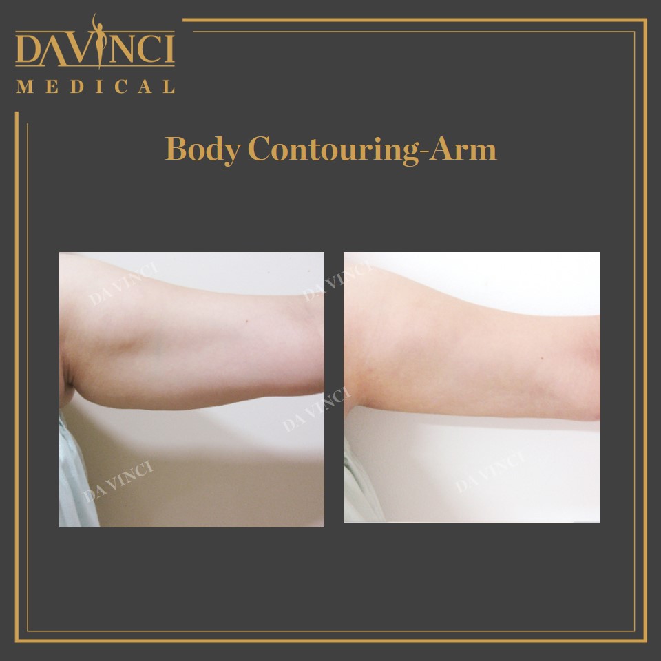 Body Contouring