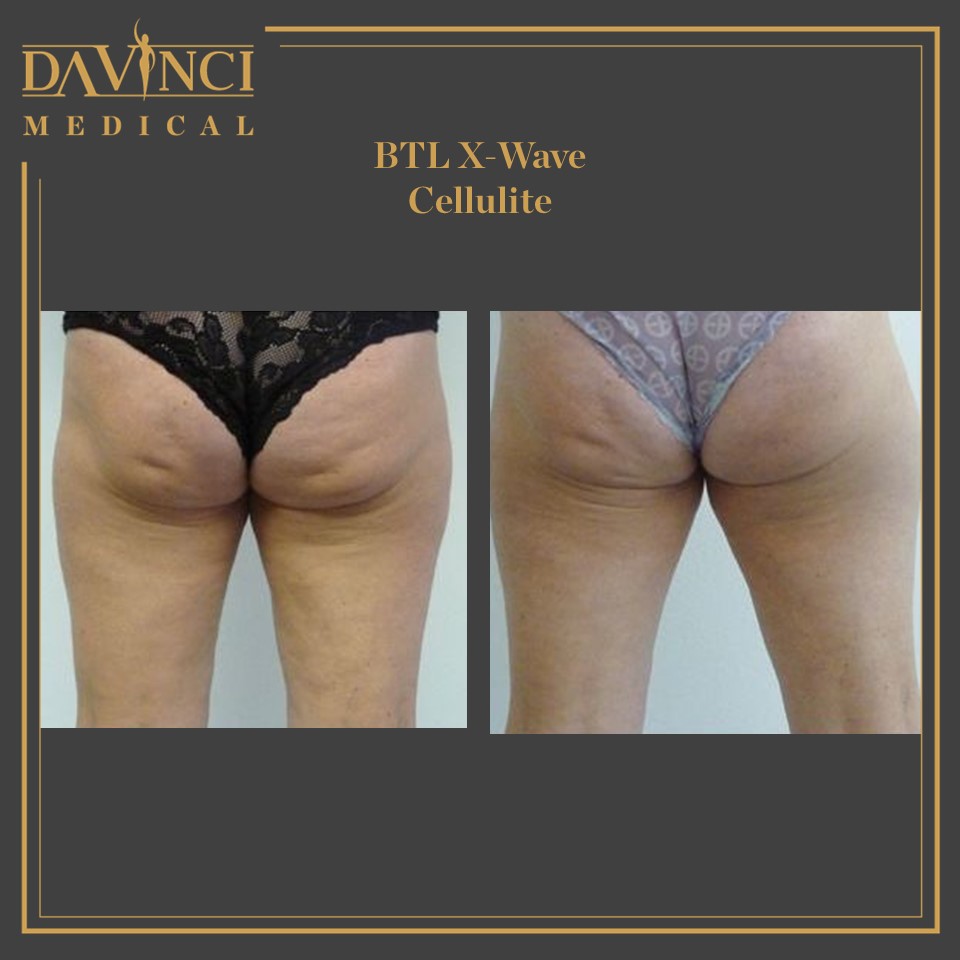 Cellulite Skin Tightening & Firming Solutions