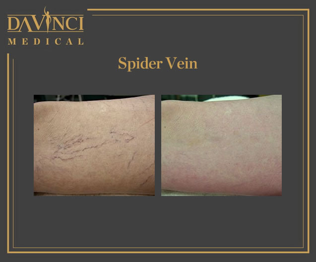 Spider Veins, Varicose & Telangectasia Solutions