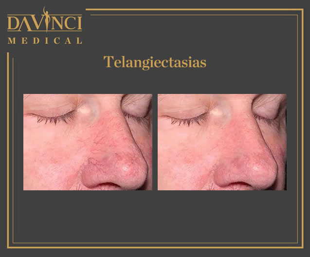 Spider Veins, Varicose & Telangectasia Solutions