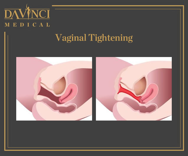 Vagina Tightening & Rejuvenation Solutions