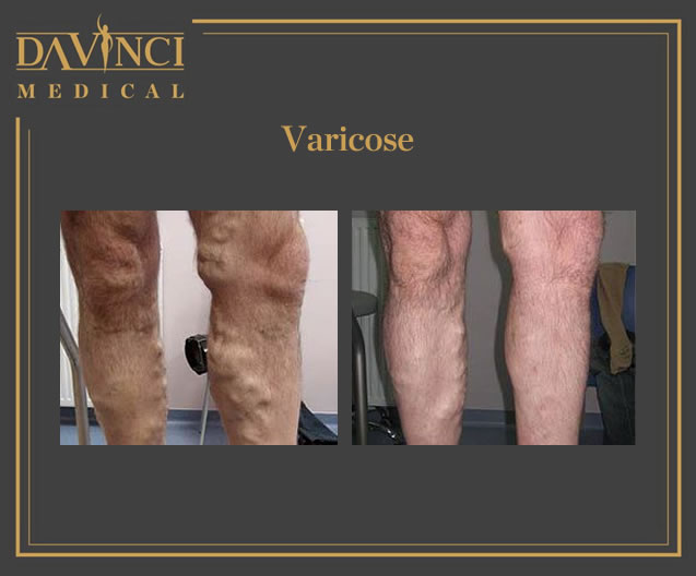 Spider Veins, Varicose & Telangectasia Solutions