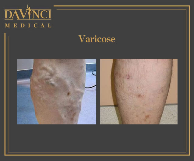 Spider Veins, Varicose & Telangectasia Solutions