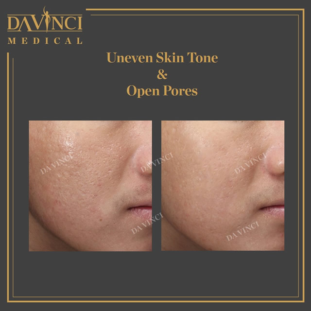Skin Texture & Open Pores