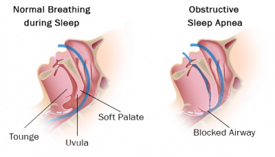 Snoring and Moderate Sleep Apnoea