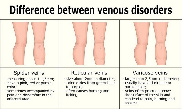 Spider Veins, Varicose & Telangectasia