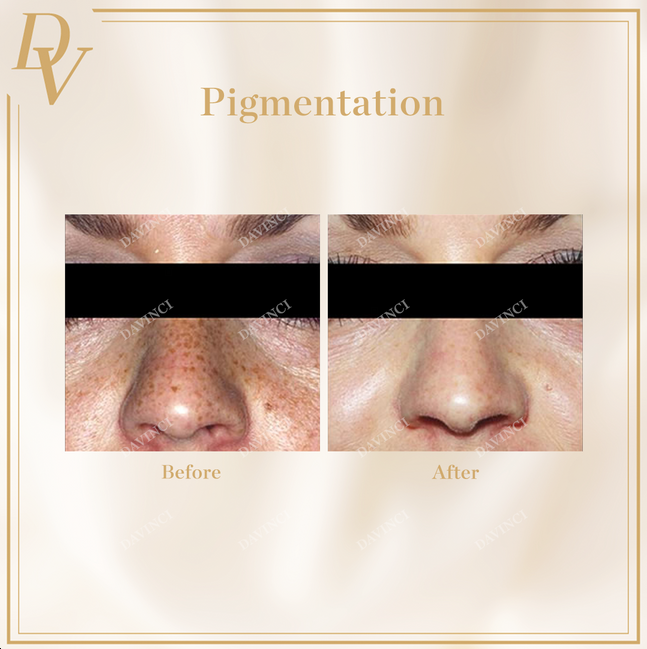 Pico Laser Before & After