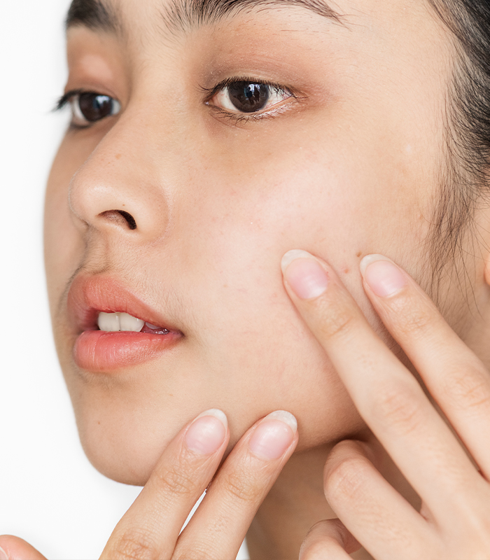 Active Acne Treatment in KL