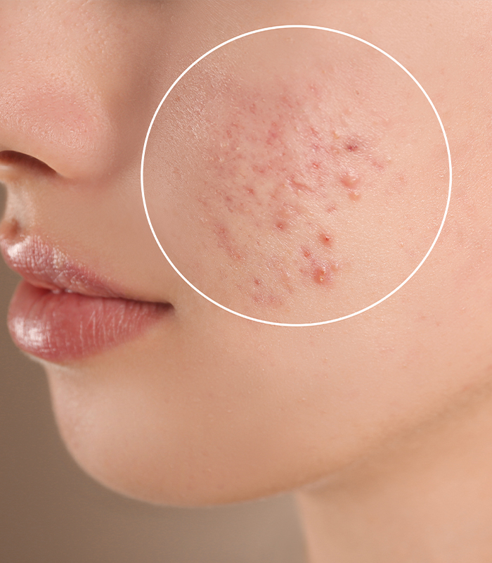 Acne Scars