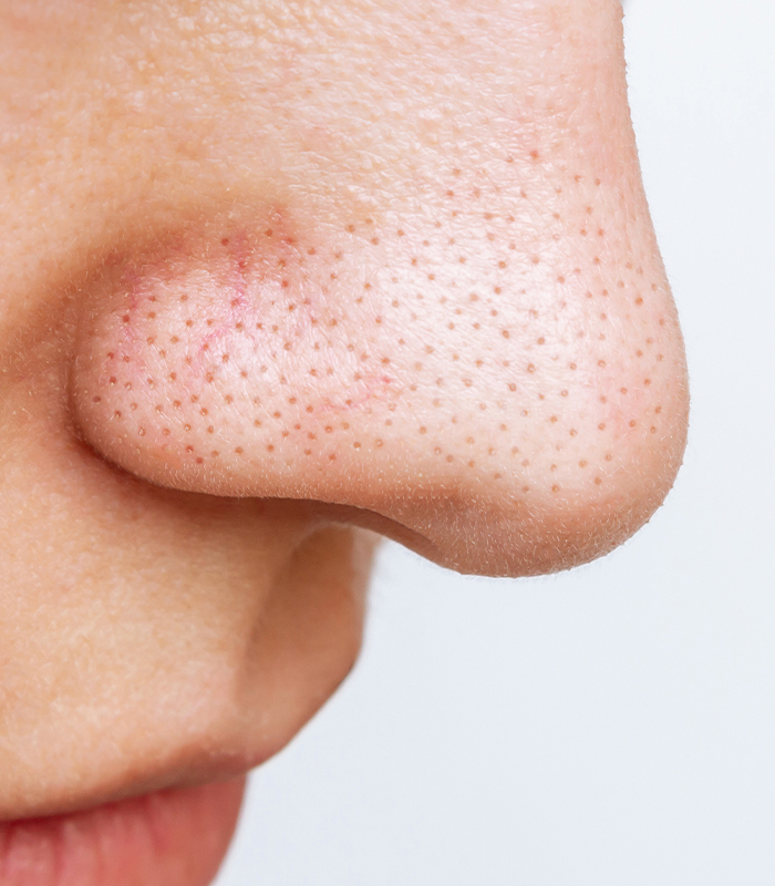 What Cause Open Pores