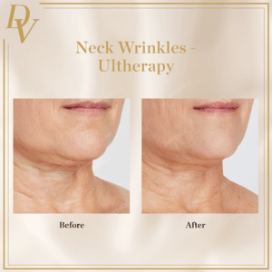 Neck Wrinkles Ultherapy
