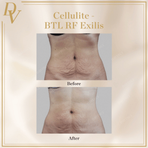 Cellulite Treatment Before & After Photos