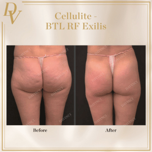 BTL RF Exilis Before & After Photos