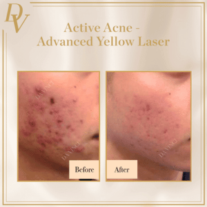 Active Acne Treatment Before and After Pictures