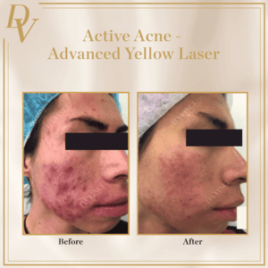 Active Acne Before & After Photos 2024