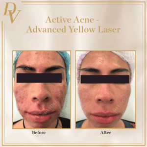 Advanced Yellow Laser Before and After