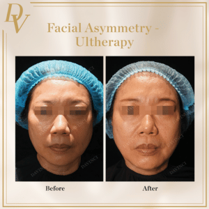 Facial Asymmetry & Saggy Ultherapy Skin 3
