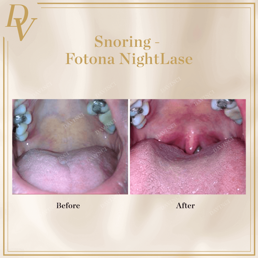 Fotona NightLase Snoring Treatment Before and After