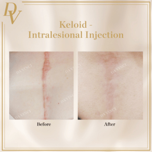 Keloid Intralesional Injection