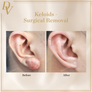 Keloid Removal Before and After