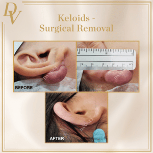 Surgical Removal