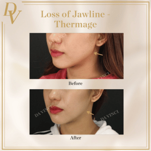 Loss of Jawline Thermage