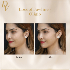 Loss of Jawline Oligio