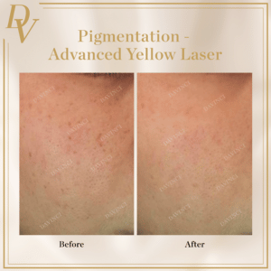 Pigmentation Removal Before & After Photos