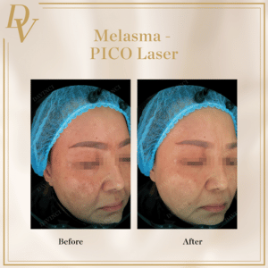Pico Laser Melasma Removal Before and After