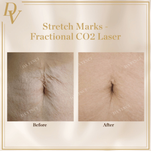 Stretch Marks Before and After Fractional CO2 Laser