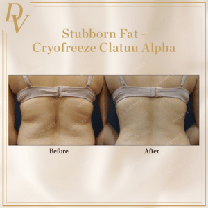 Stubborn Fat Removal Before and After