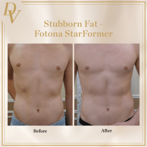 Stubborn Fat Removal Before and After using Fotona StarFormer
