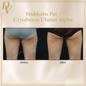 Cryofreeze Clatuu Alpha Before & After